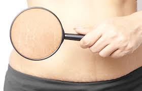 how to remove your stretch marks fast